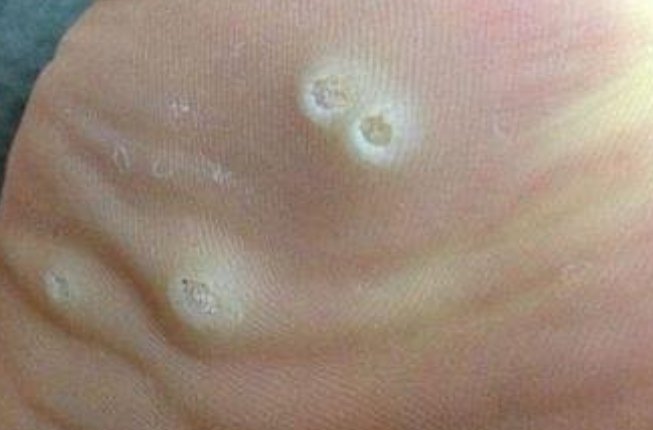 怎么确定鸡眼根,是否挖出来了