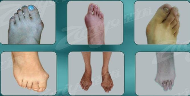 我的脚趾有拇外翻吗？？如图