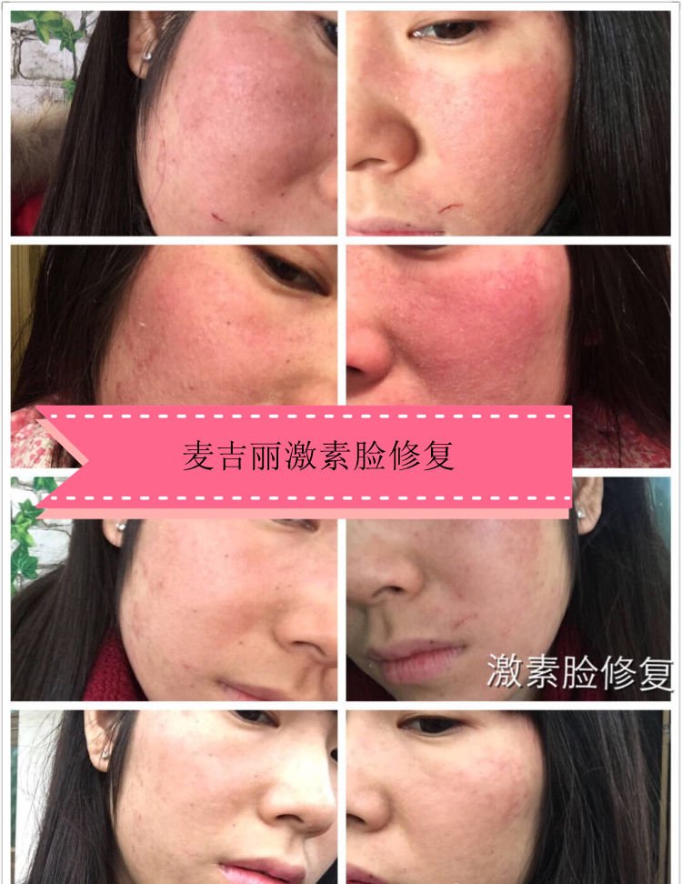 激素依赖性皮炎可以用麦吉丽化妆品最新曝光