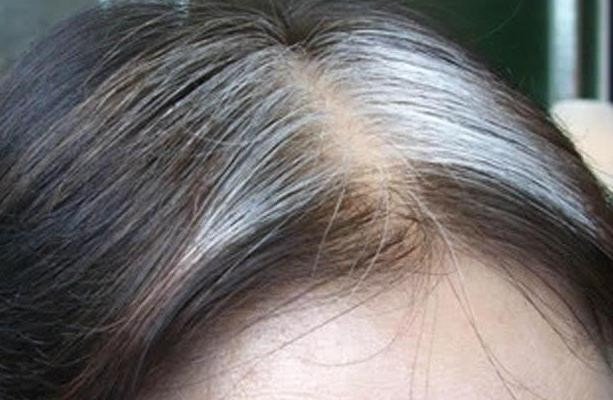 少年白发变黑发最好的方法是什么？