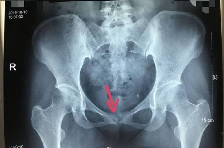 pubic是什么意思