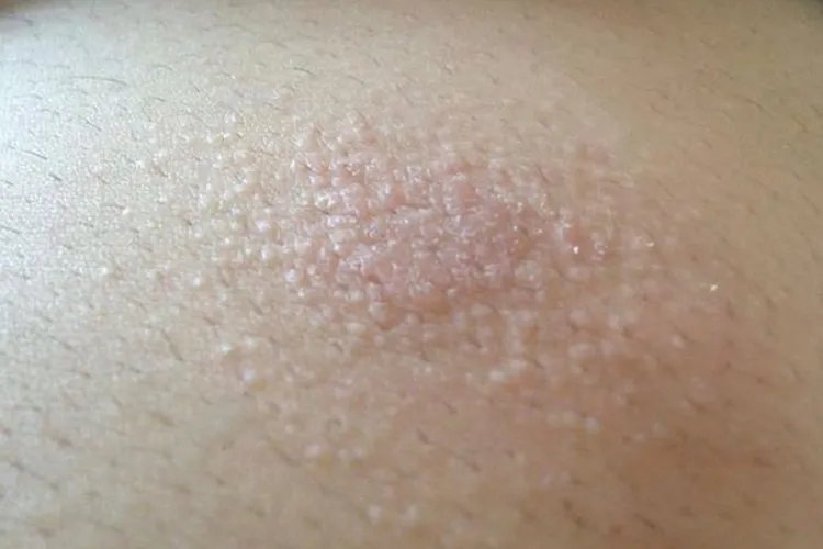 宝宝身上起痱子图片