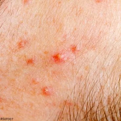 汗疱疹是什么原因引起 汗疱疹与这些原因密切相关