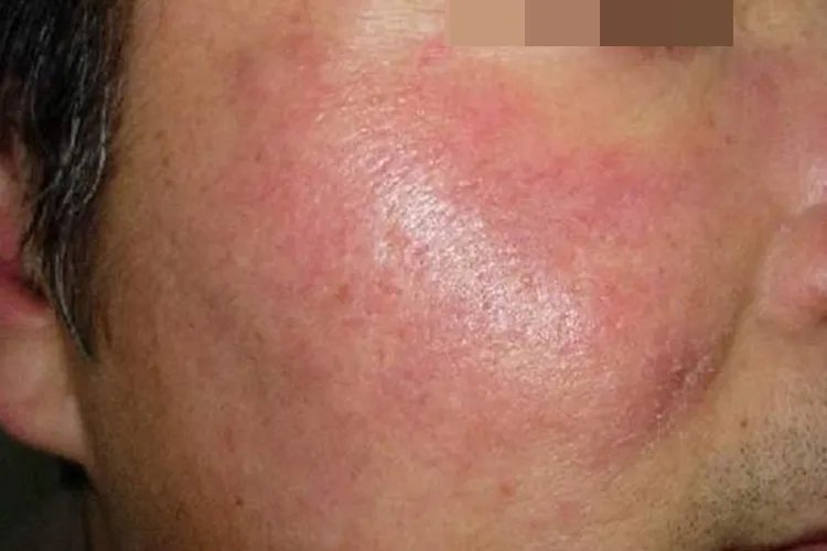 各种面部皮炎症状图片大全