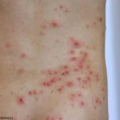 丘疹性皮炎可以用醋酸曲安奈德吗