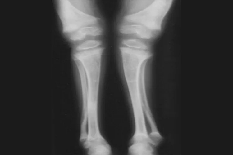 佝偻病儿童图片