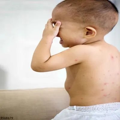 出水痘要怎么处理