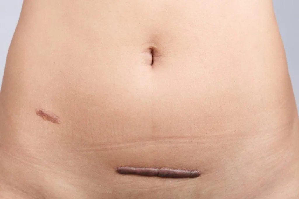 剖宫产正常疤痕图片