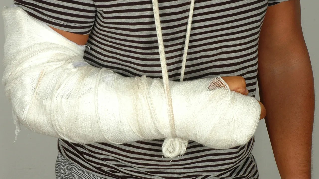 什么是尺骨鹰嘴骨折