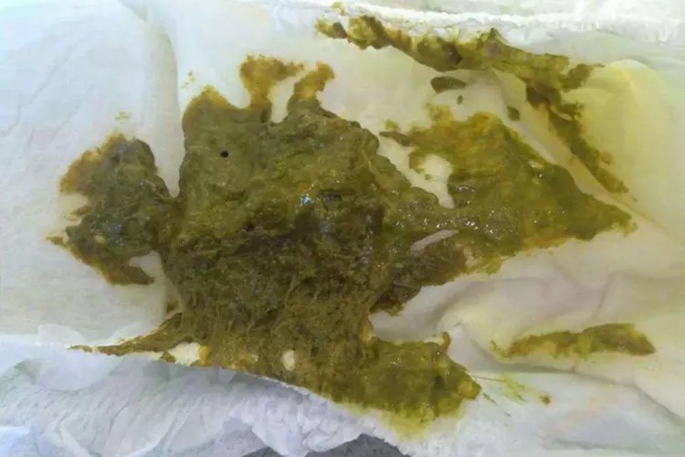 正常新生儿粑粑图片