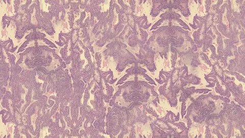 异型淋巴细胞是什么