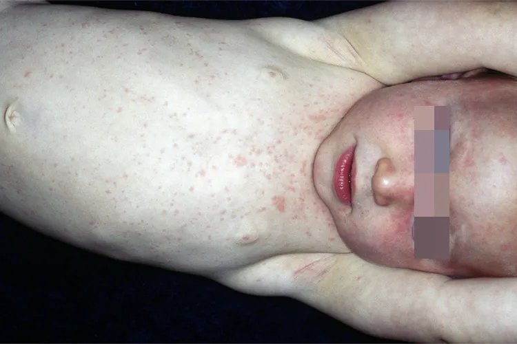 宝宝前胸后背红疹图片