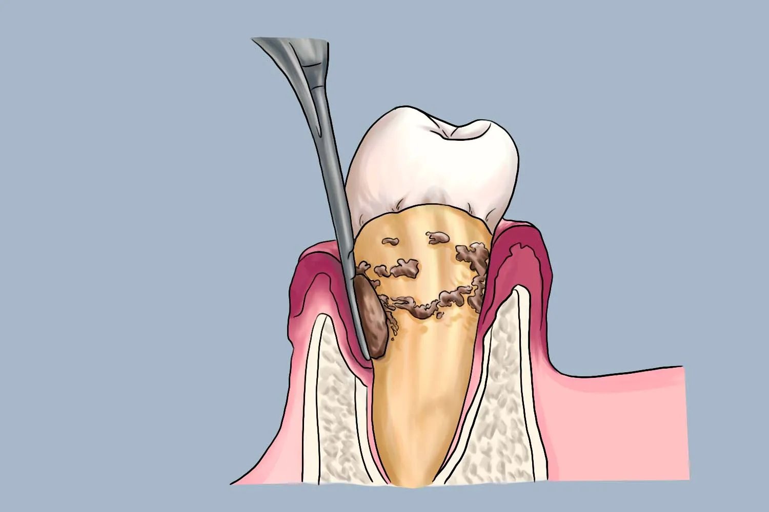 藏在牙龈里的牙结石图片