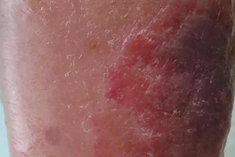丹毒水疱图片