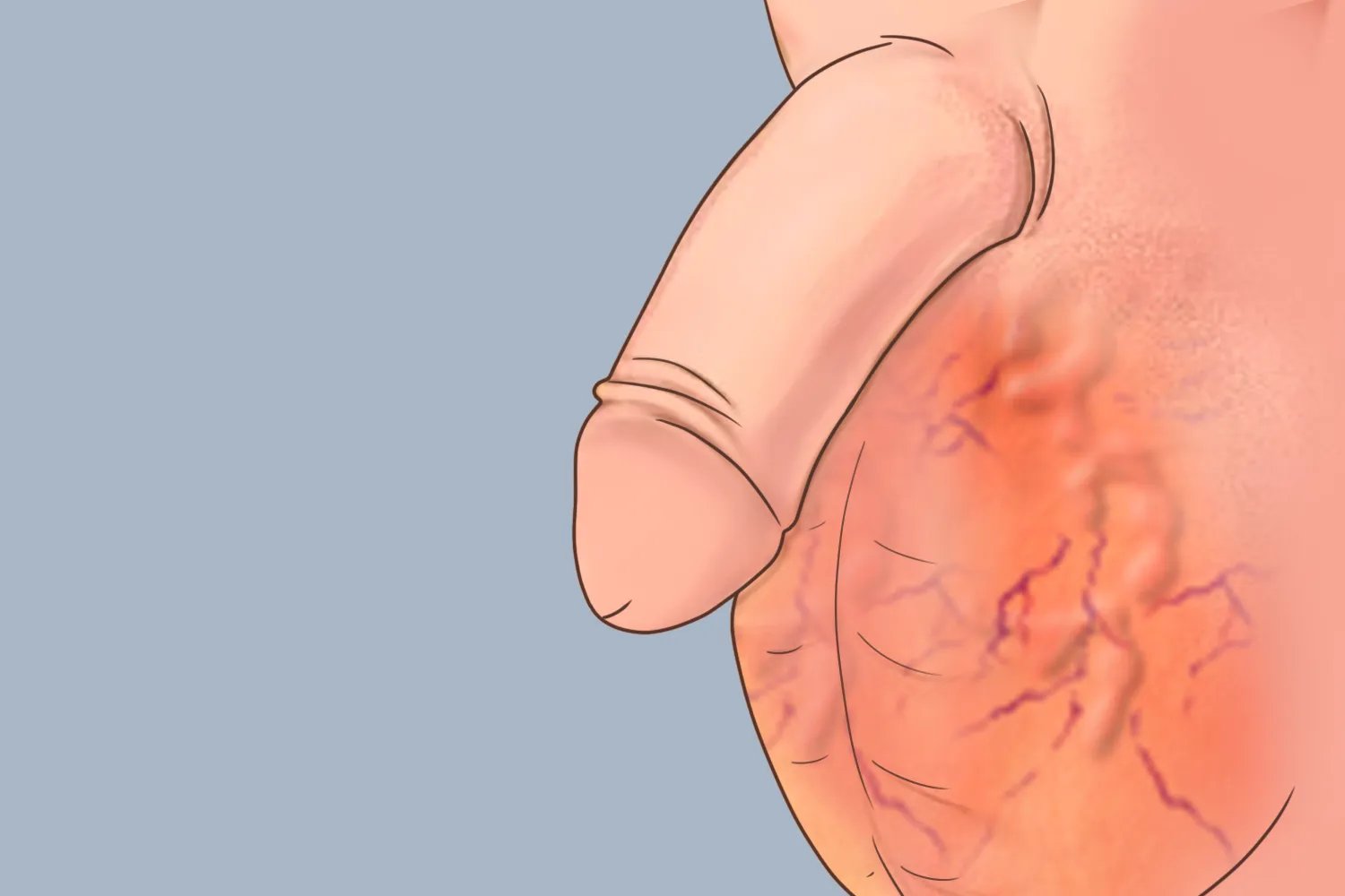 什么是静脉曲张图片