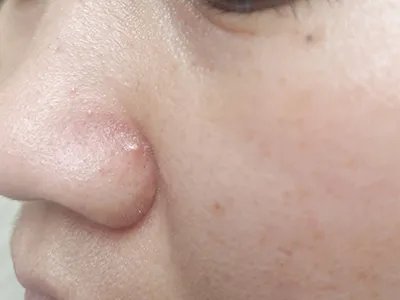 毛囊炎疙瘩图片