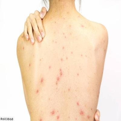 背后长痘痘是什么原因导致的