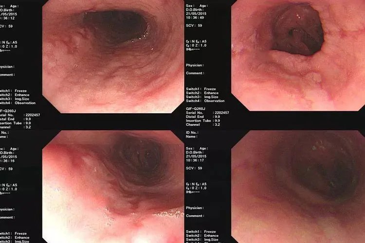 反流性食管炎症状表现