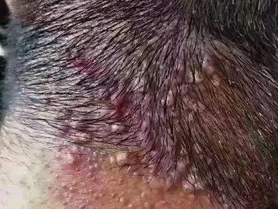 毛囊炎疙瘩图片