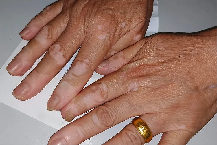 白色斑点初期症状图片