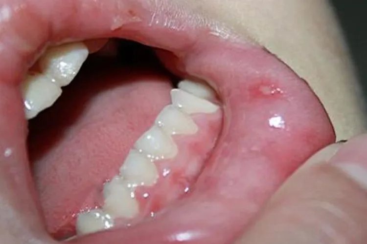 手足口病图片及治疗方法