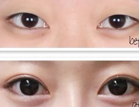 开眼角割双眼皮一般价格多少