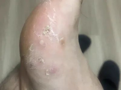 水疱型足癣脚部水疱图片