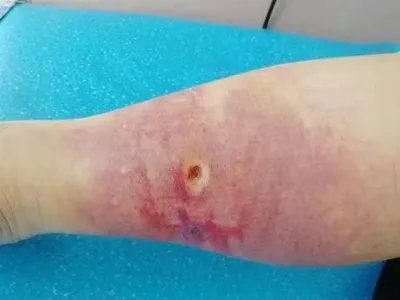 蜱咬伤红肿图片