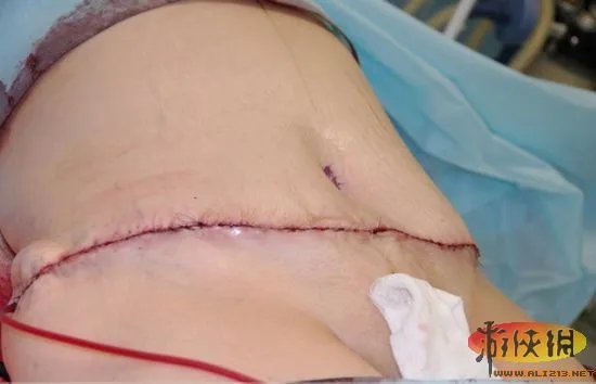 实拍恐怖整形吸脂手术全过程　胆小者慎入！