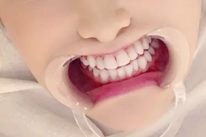 补牙材料价格表有哪些?