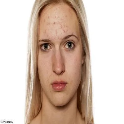 硫磺软膏可以治疗疥疮吗