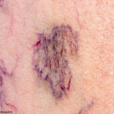 单纯性紫癜的症状表现有哪些