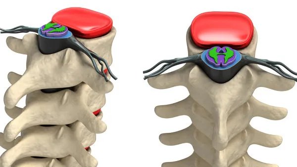 椎管狭窄必须做手术吗 椎管狭窄的手术指征