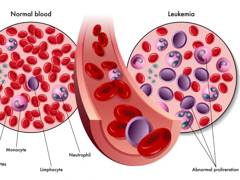 伊马替尼的副作用