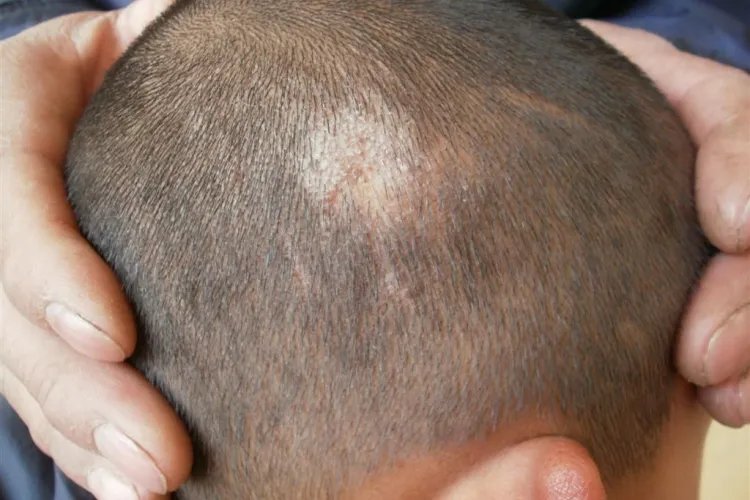 头癣的症状图片