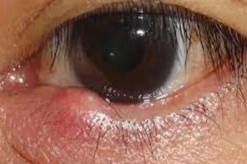 下眼睑红肿图片