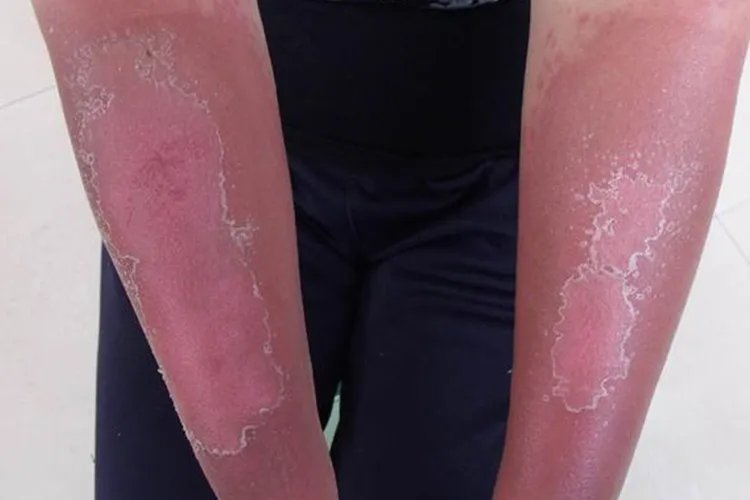 皮炎的10种症状图片