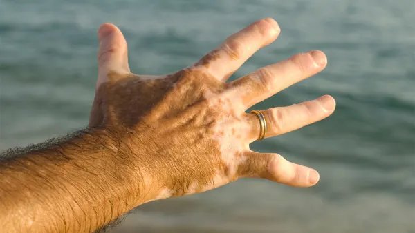 指甲长白斑什么原因