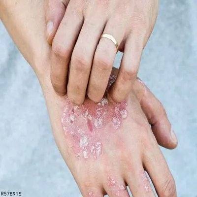 中重度银屑病治疗方法有哪些