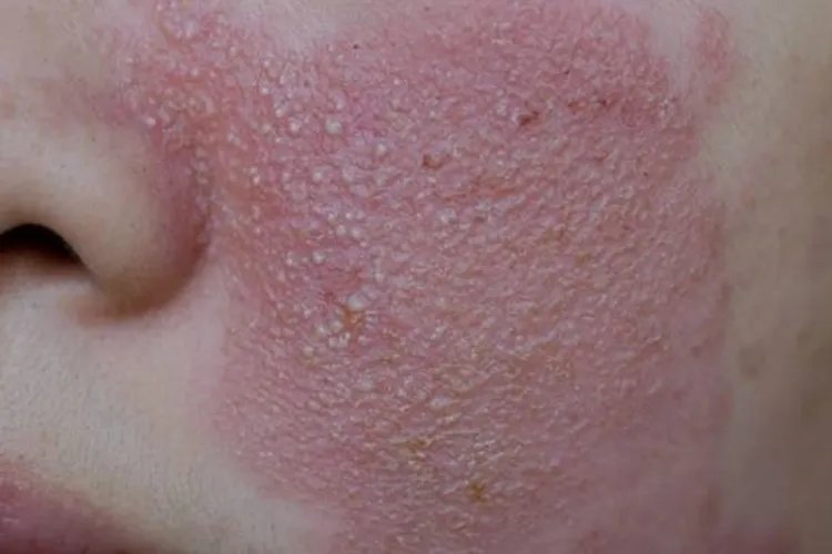 各种面部皮炎症状图片大全