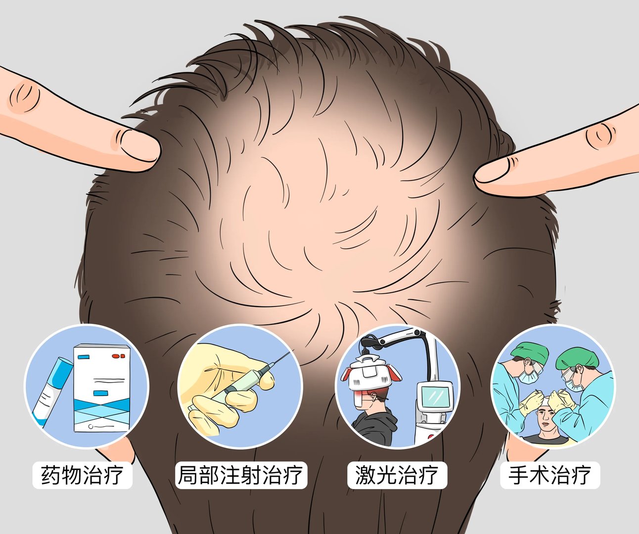 治疗秃顶的好方法