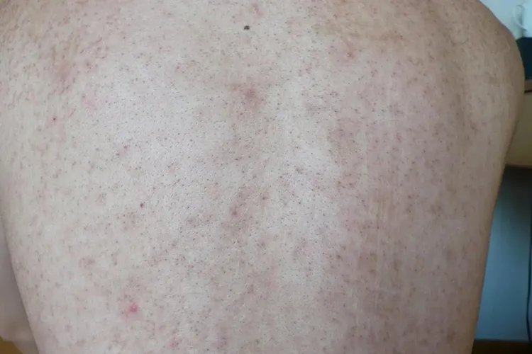 背部毛周角化症图片