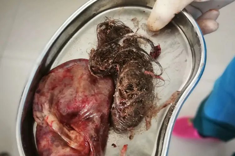 肌胎畸胎瘤图片