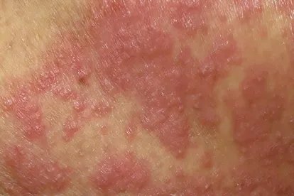 念珠菌皮疹图片