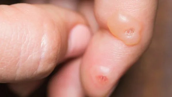 手上长水泡怎么办，手上长水泡的注意事项有哪些？