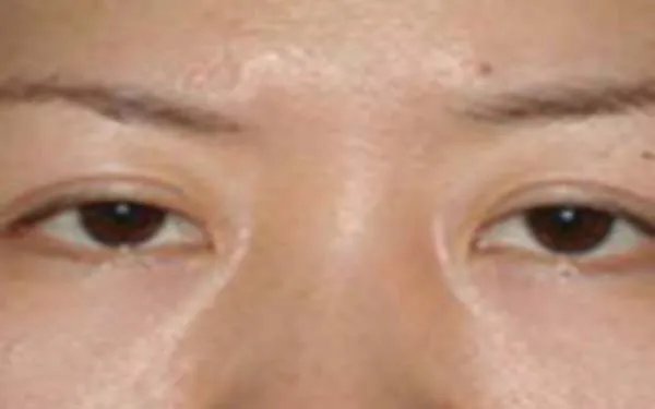 北京做双眼皮好的医院在哪里?