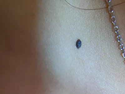 皮内痣黑痣图片