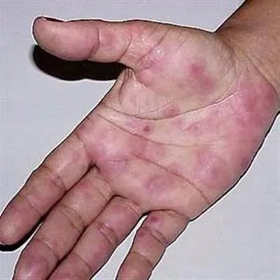 系统性红斑狼疮传染吗