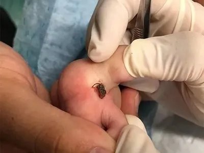 蜱咬伤红肿图片