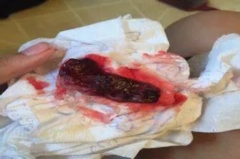 掉下来的完整孕囊图片